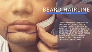 کاشت ریش و سیبیل