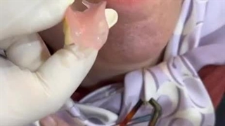 فیلم دندان  تیکه ای  ژله ای - کلینیک مستردندان