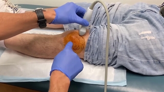 ویدئویی از انجام پی آر پی زانو