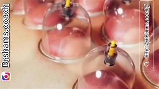 ماساژ و کاپینگ تراپی