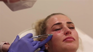 ویدئو کاملی از انجام تمام مراحل پی آر پی زیر چشم