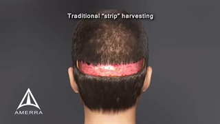 جدیدترین روش های کاشت مو