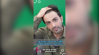 النتائج المبهرة لزراعة الشعر بعد عام