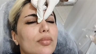 تزریق بوتاکس فول فیس