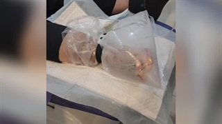 اوزون تراپی تسریع کننده درمان زخم - کلینیک درمان زخم تلما