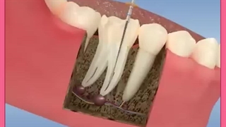 نوک ریشه عفونت کرده