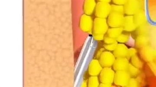 لیپوساکشن چیست؟