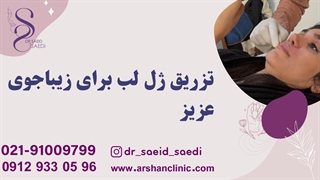 تزریق ژل لب برای زیباجوی عزیز