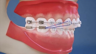 Class II Elastics - Lateral View (HD Edition)