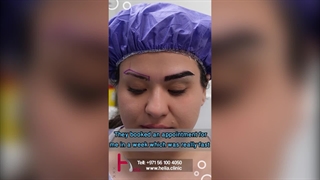 Eyebrow transplantation- ensuring the density and natural appearance of eyebrows