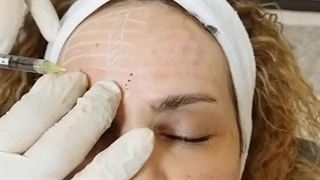 تزریق مزوجوانساز رویتاکر