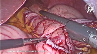 عمل جراحی تومور جیست معده