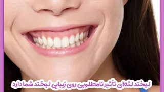جراحی لثه برای اصلاح لبخند لثه ای