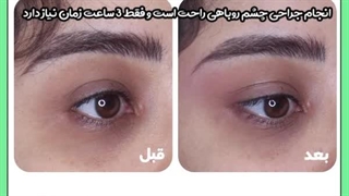 آیا می توان همزمان با بلفاروپلاستی عمل چشم روباهی هم انجام داد ؟