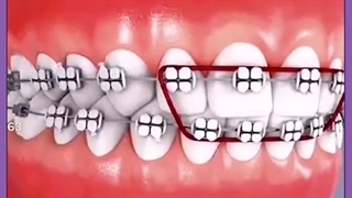 علت فاصله افتادن بین دندانها