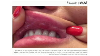 گرانولوم ناشی از تزریق لب چیست؟ [5 راه پیشگیری از آن]