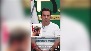 High Density Hair Transplant No Shedding 18 Months Later