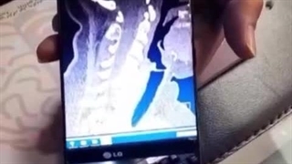 ضایعه کلسیفیه نخاع گردنی