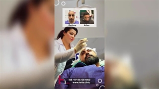 Hair transplant high density, natural appearance