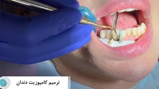 ترمیم کامپوزیت دندان