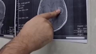 امید به زندگی با پایان تشنج های دردناک مادر 70 ساله