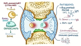 روماتیسم مفصلی یا آرتریت روماتوئید - علل، علائم، تشخیص، درمان، آسیب شناسی