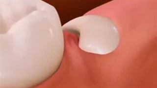 برداشتن دندان عقل کاشته شده