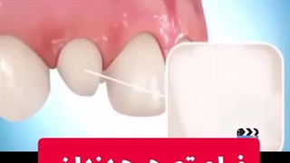 نحوه تصحیح کردن دندان