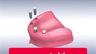 نحوه گذاشتن اوردنچر