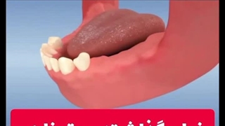 نحوه گذاشتن پروتز فلزی