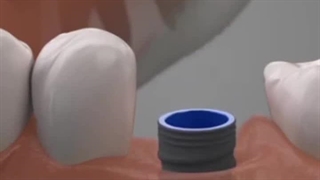 نحوه گذاشتن ایمپلنت