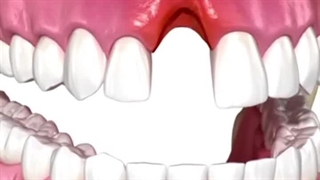 بازسازی دندان و لثه تحلیل رفته