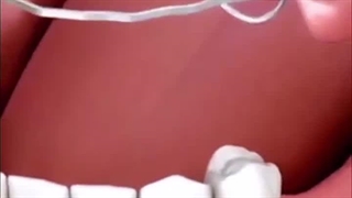 فیلم گذاشتن پروتز پارسیل متحرک