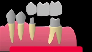 پروتز ثابت موقت