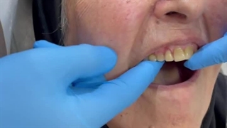 فیلم دندان تیکه ای ژله ای جایگزین ایمپلنت