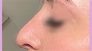 سوپر لیفت بینی اروپایی