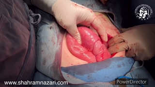 درهم‌روی روده