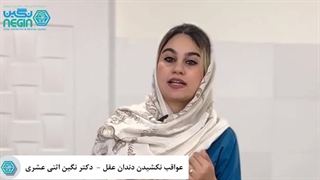 عواقب نکشیدن دندان عقل نیمه روییده - دکتر نگین اثنی عشری پوسیدگی دندان
