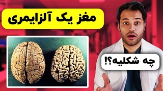مغز یک آلزایمری چه شکلیه؟!