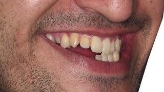 ارتودنسی و جراحی ناهنجاری جلو بودن فک پایین