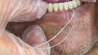 فیلم برطرف کردن لقی دندان مصنوعی