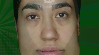 فیلم قبل و بعد از جراحی فک و صورت