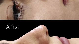 تزریق فیلر بینی