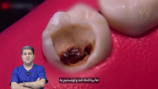 مراحل عصب کشی دندان