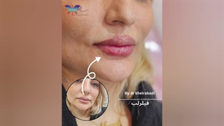 نمونه‌ای از تزریق فیلر لب (4)