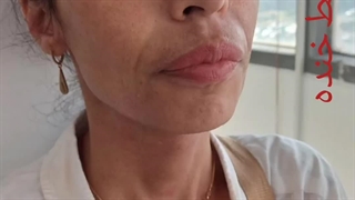 تزریق فیلر خط خنده