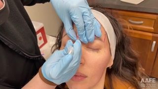 ویدئویی از انجام بوتاکس توسط متخصص