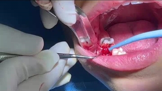 مثب 13+ -- کشیدن دندان با خالی کردن کیست عفونت