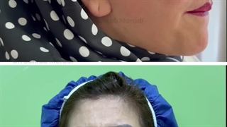 جراحی کامل لیفت صورت و عمل زیبایی بینی