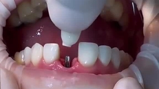 نحوه جایگذاری ایمپلنت دندان در کرج ( دندانپزشکی شبانه روزی دریا )